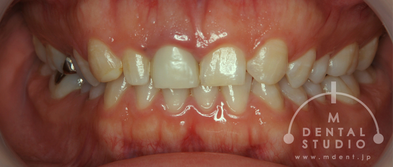 歯が小さいこと、左右非対称な歯の形がコンプレックスです。 治療実績集 審美治療【大阪の歯科クリニック】MDENTAL STUDIO