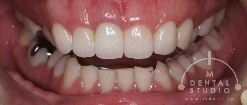 歯が小さいこと、左右非対称な歯の形がコンプレックスです。 治療実績集 審美治療【大阪の歯科クリニック】MDENTAL STUDIO