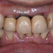 【中度】このままでは、前歯が3本ともが、歯茎が下がって歯が抜け落ちそう...歯周病で！