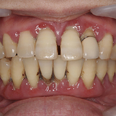 【重度歯周病】歯がぐらぐら治るために！触ると抜ける！型取りすら出来ない！Part2