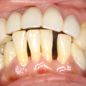【中度】下の前歯の歯ぐきが痩せ、すき間が大きく開いて、もう抜けそ～うに見える！
