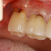 【過去を振り返る】奥歯の歯ぐきの腫れ（ハレ）について【分岐部病変】