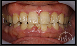 【中度】奥歯も含め中度の歯周病！特に下の前歯はもう大変！