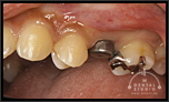 審美インプラントVol.19永久歯の先天性欠損によるインプラント技術