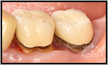 【軽度】奥歯の虫歯と歯周病の併発