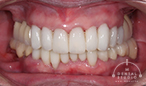 「歯を残すという治療・技術」を施すと、歯ぐきは何歳まで回復するのか?81歳 女性