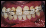 【重度】30代女性「歯がボロボロ」インプラント10本以上必要と診断されたのですが・・・。