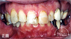 施術前写真(正面)