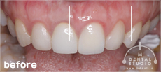 施術前写真(上前歯)