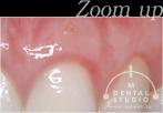 拡大写真(腫れのある歯ぐき)