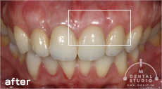 施術後写真(上前歯)
