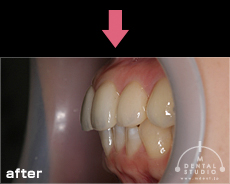 施術後写真(横から見た口周り)