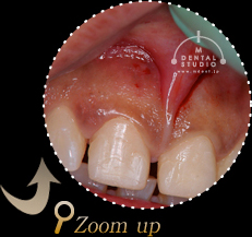 施術前拡大写真(前歯)