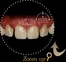 施術後拡大写真(前歯)