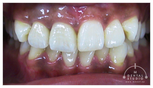 上の写真の、どの歯が「天然歯」か分かりますか？