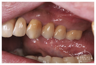 上の写真の、どの歯が歯根が無いか分かりますか？