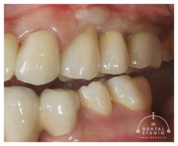 上の写真の、どの歯をインプラント治療しているでしょうか？