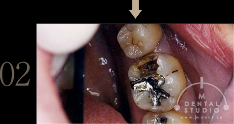 02.銀歯取り外し後