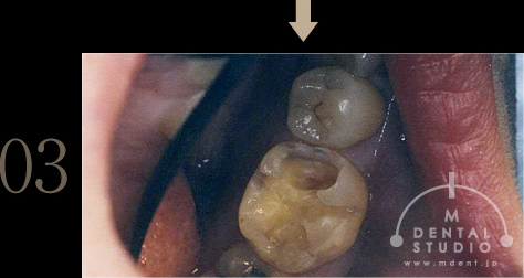 03.虫歯を除去