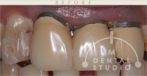 施術前写真(上前歯)