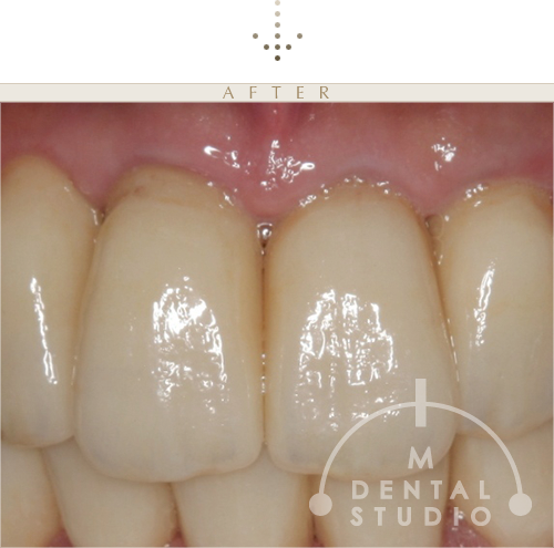 施術後写真(上前歯)