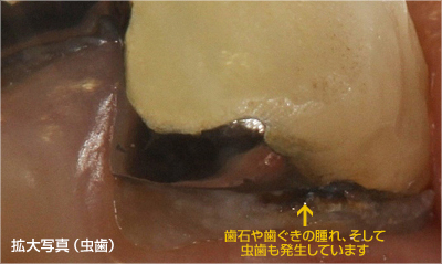 虫歯拡大写真