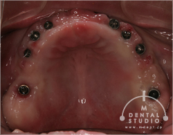 インプラント埋入写真