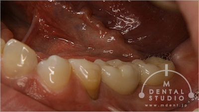 施術後写真(下顎左側奥歯)