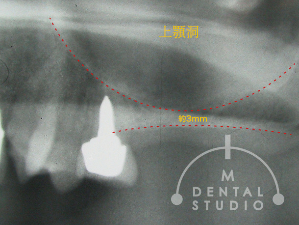 レントゲン写真(上顎骨の骨)
