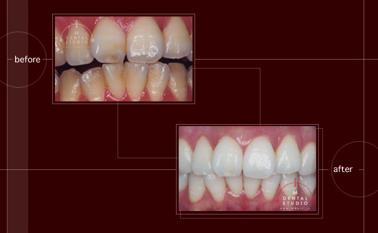 保険治療のクリーニングの施術前後写真