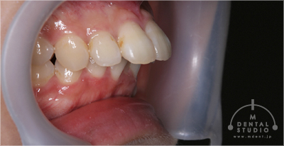出っ歯 時間短縮を目指し セラミック治療による矯正技術 治療実績集 矯正治療 大阪の歯科クリニック Mdental Studio