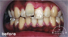 施術後写真(前歯)