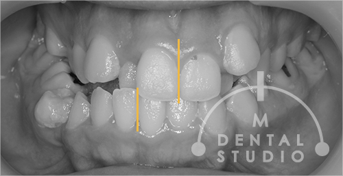 正面写真(術前)