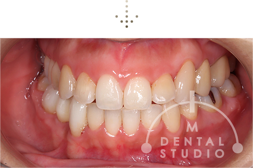 正面写真(術後)