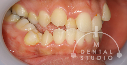 左側から見た写真(術前)