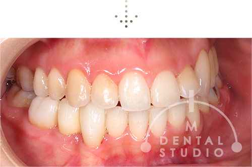 左側から見た写真(術後)