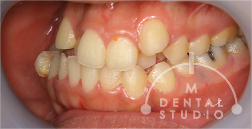 右側から見た写真(術前)