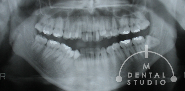 レントゲン写真(術前)