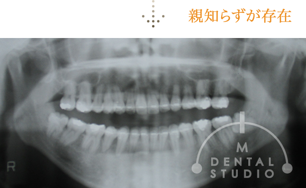 レントゲン写真(術前)