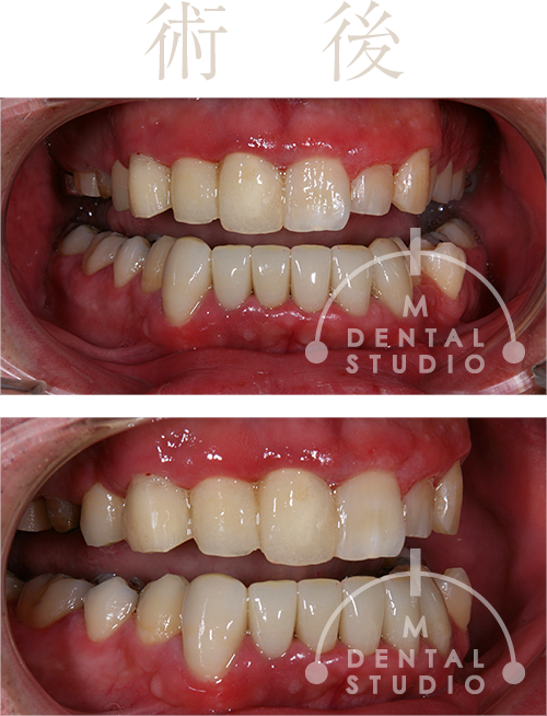 術後写真(正面・右側)