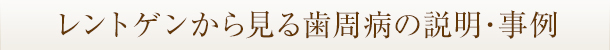 レントゲンから見る歯周病の説明・事例