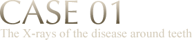 CASE 01 The X-rays of the disease around teeth