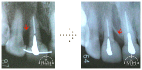 動揺のある歯ぐき(治療前後のレントゲン写真)