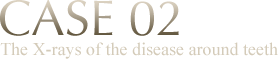 CASE 02 The X-rays of the disease around teeth