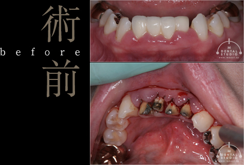 術前写真(下顎・奥歯)