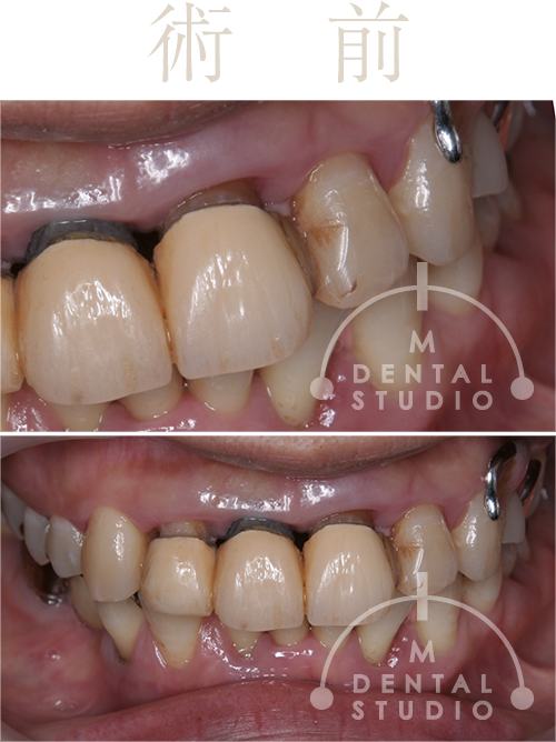 施術前写真(左側/正面)