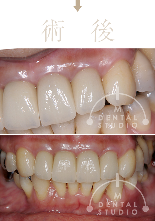 施術後写真(左側/正面)