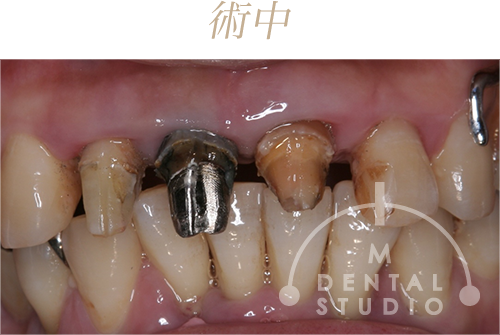 治療中の現状写真(正面)