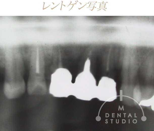 レントゲン写真(正面)