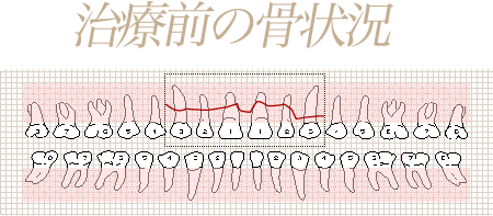 治療前の骨状況(図)